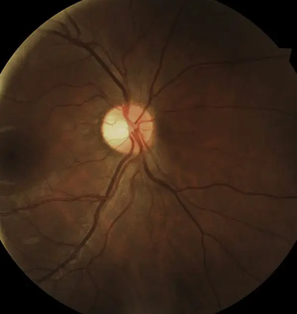 Retina Screening of Macula